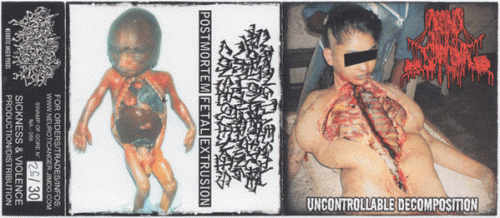 Wrong Illegal Abortion Procedure With Alarming Consequences : Carcinosarcoma - Wrong Illegal Abortion Procedure with Alarming Consequences